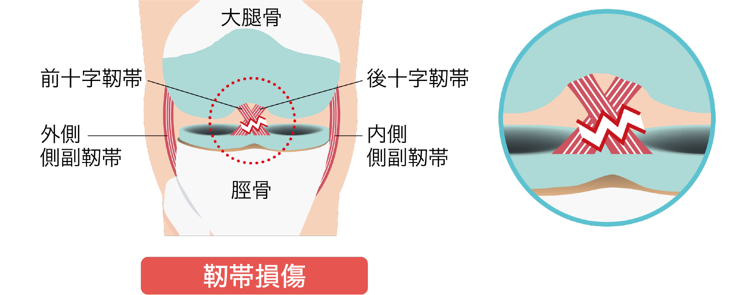 ひざ関節の靭帯損傷（ひざの捻挫）