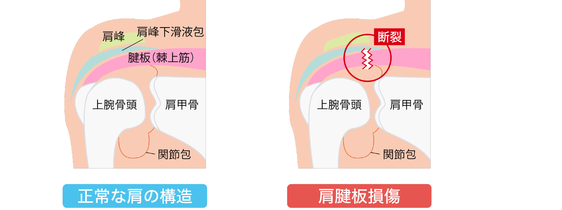 肩腱板損傷(四十肩・五十肩)