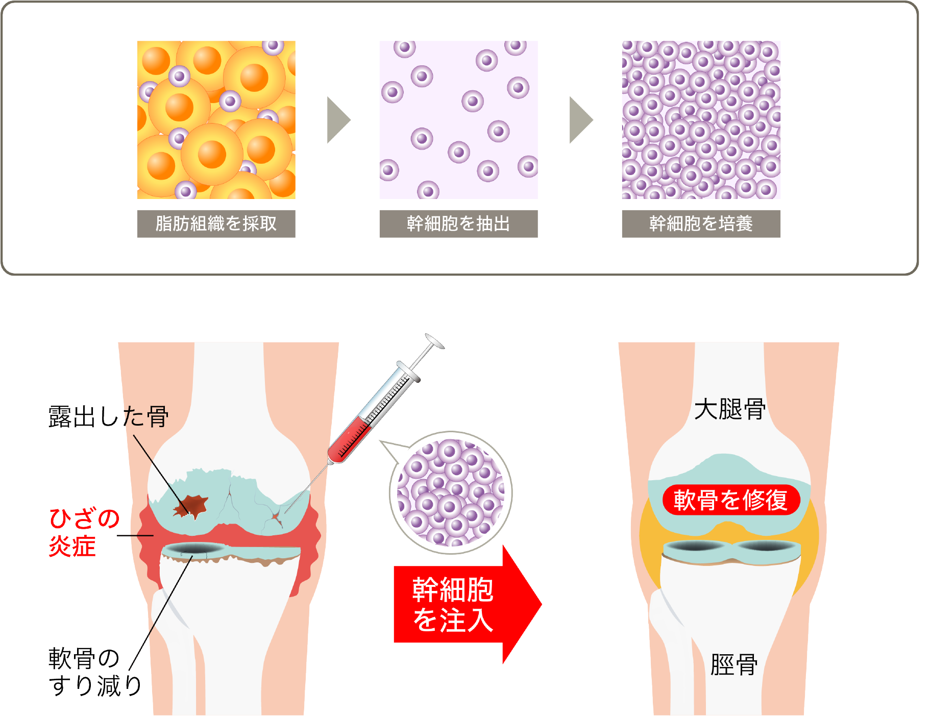 幹細胞治療による関節症治療