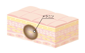 しみ・あざが発生