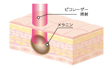 ピコレーザーを照射