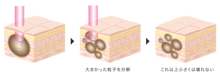 従来のレーザー