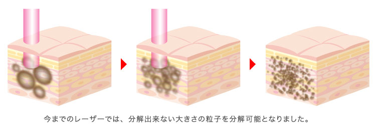 ピコレーザー